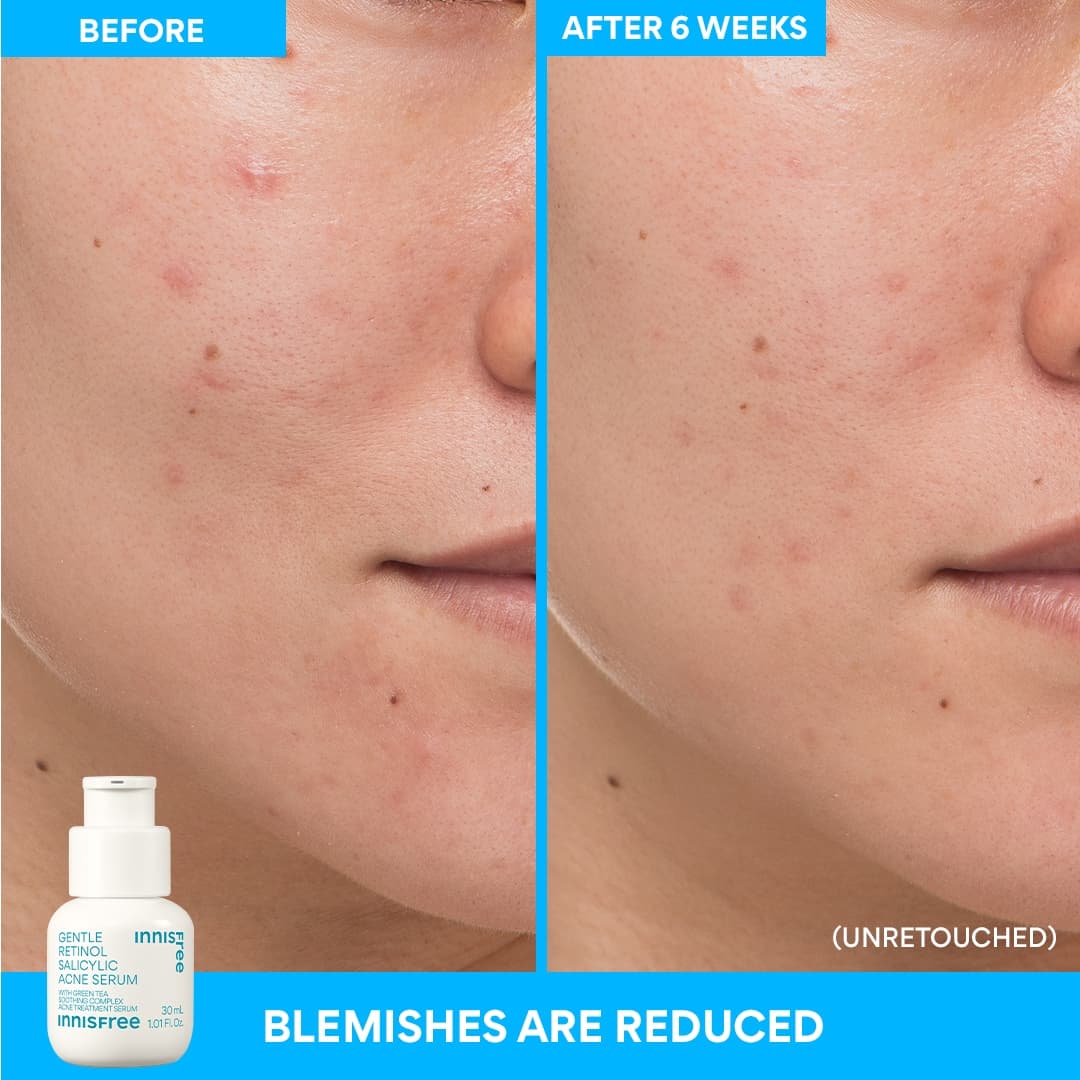 28-gentle-retinol-salicylic-acne-serum-10.jpg Gentle Retinol Salicylic Acne Serum