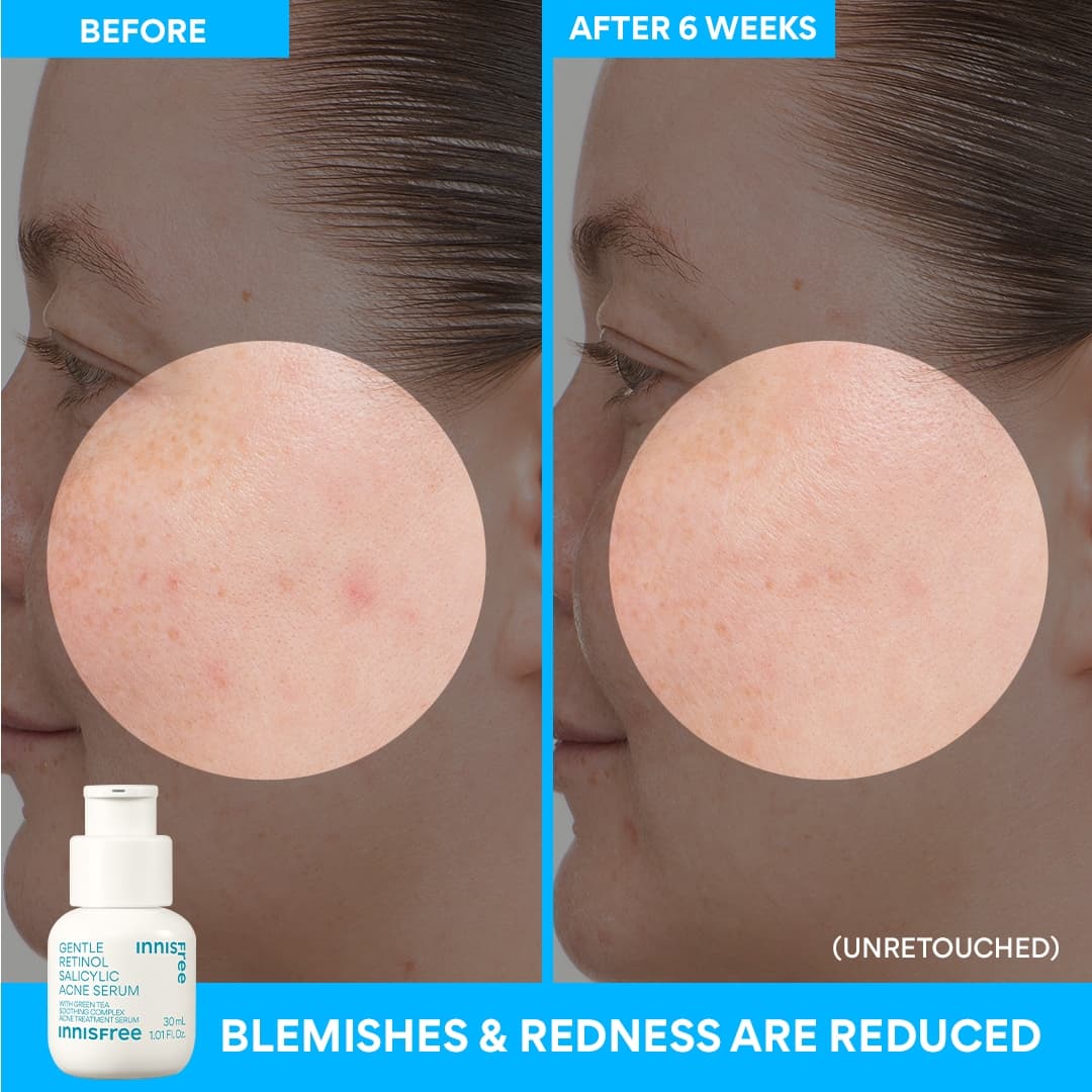 28-gentle-retinol-salicylic-acne-serum-12.jpg Gentle Retinol Salicylic Acne Serum
