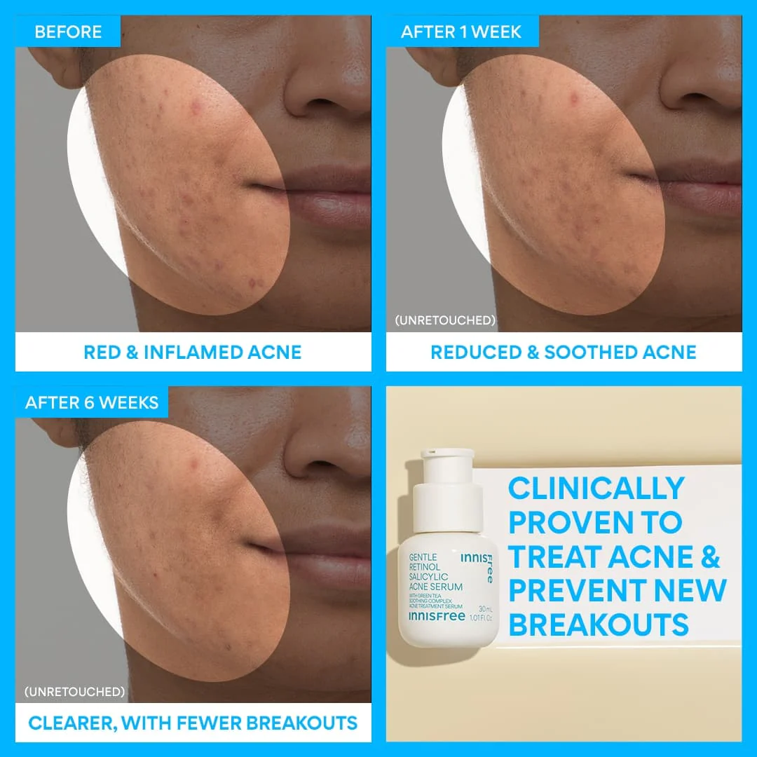 28-gentle-retinol-salicylic-acne-serum-4.webp Gentle Retinol Salicylic Acne Serum