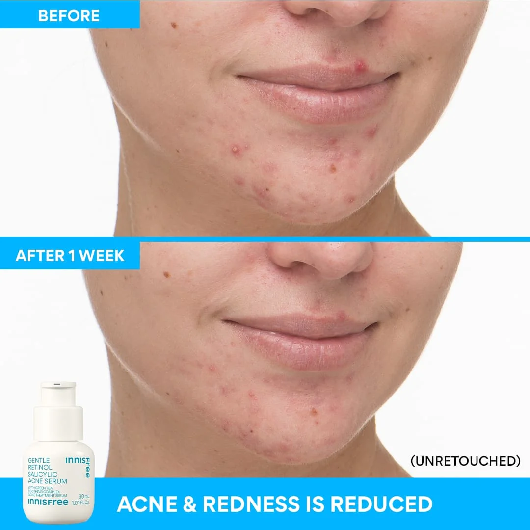 28-gentle-retinol-salicylic-acne-serum-5.webp Gentle Retinol Salicylic Acne Serum